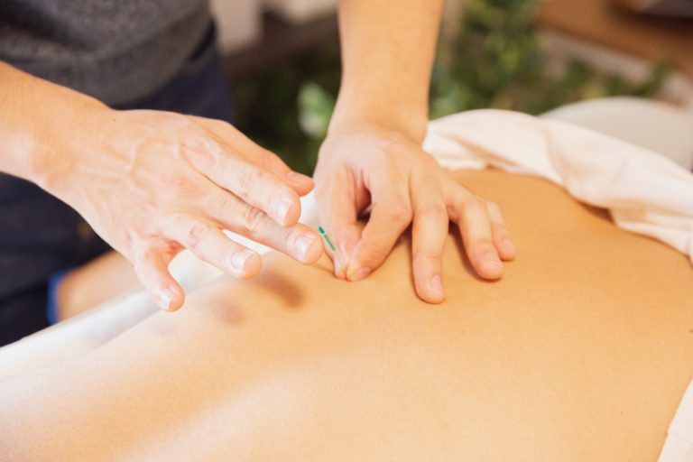 acupuncture therapy in Edmonton